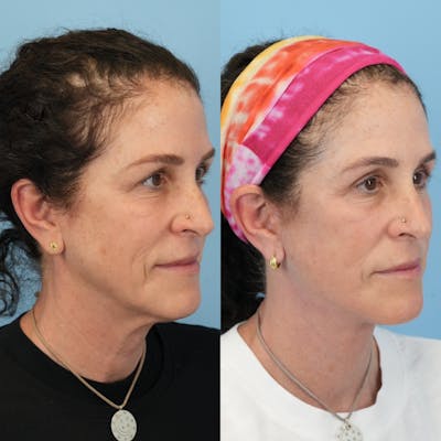 Facelift Before & After Gallery - Patient 719613 - Image 2