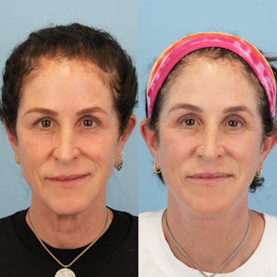 Facelift Before & After Gallery - Patient 719613 - Image 1