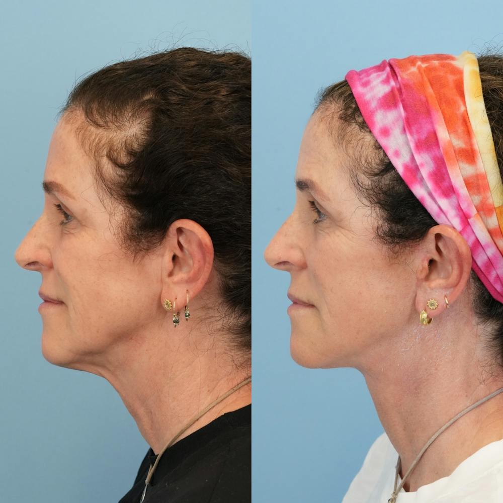 Facelift Before & After Gallery - Patient 719613 - Image 5