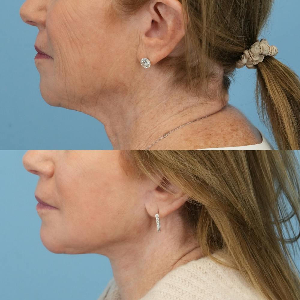 Facelift Before & After Gallery - Patient 300532 - Image 5