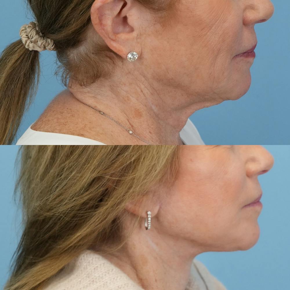 Facelift Before & After Gallery - Patient 300532 - Image 3