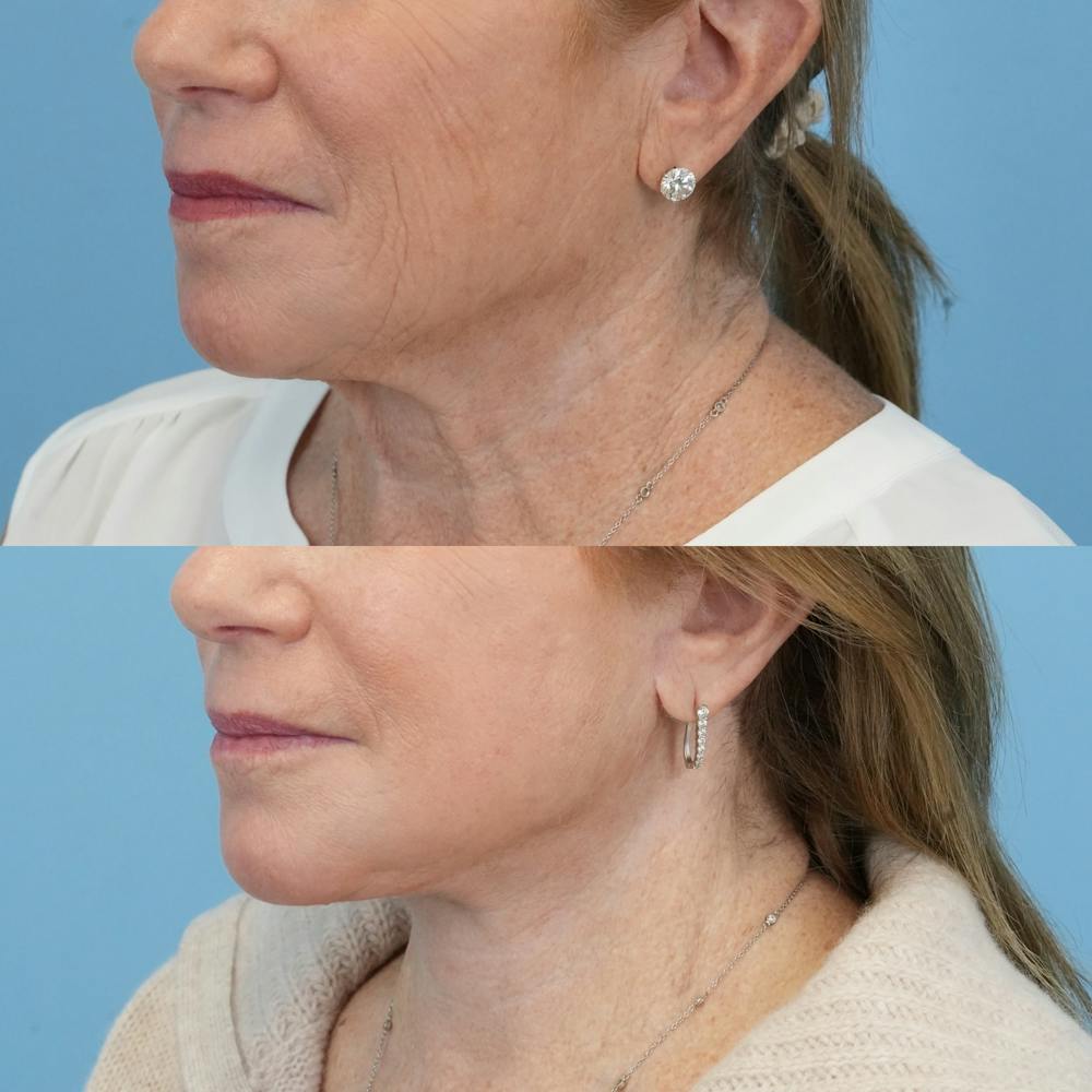 Facelift Before & After Gallery - Patient 300532 - Image 4