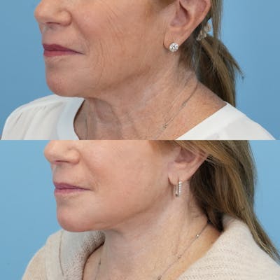 Facelift Before & After Gallery - Patient 300532 - Image 4