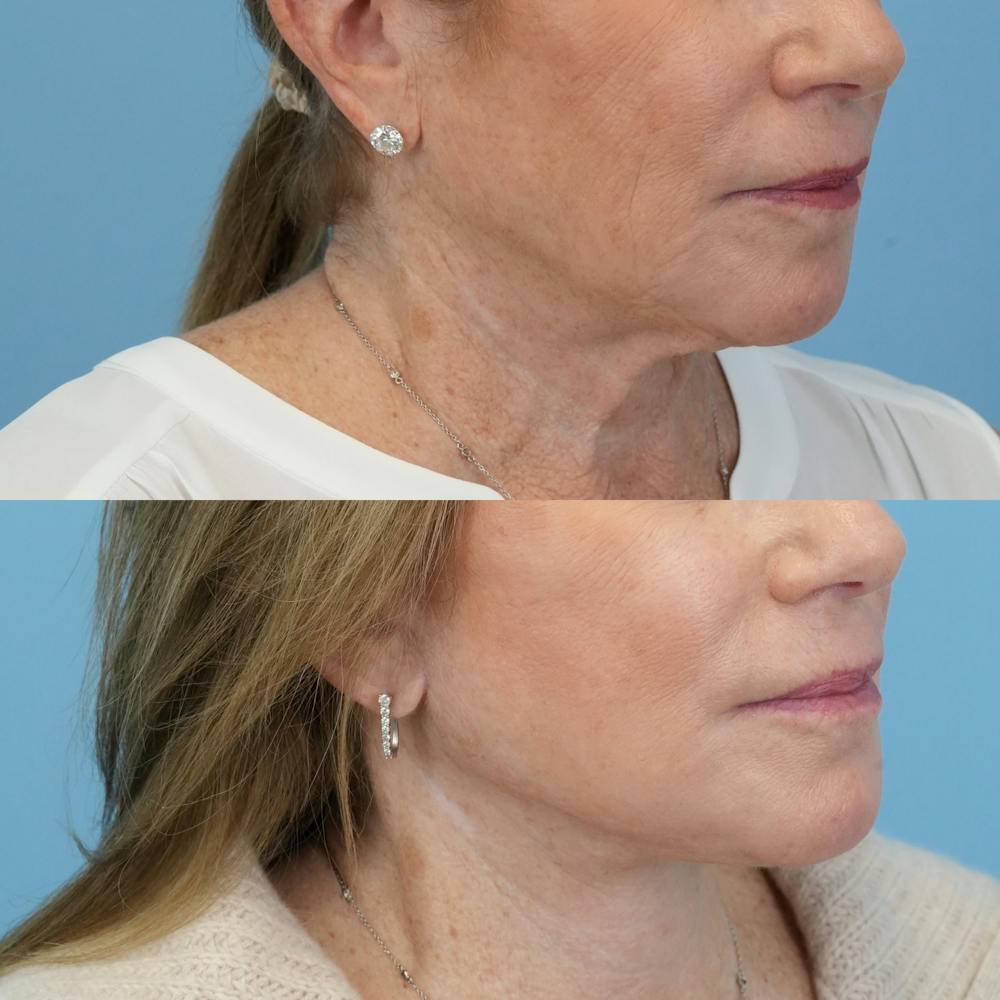 Facelift Before & After Gallery - Patient 300532 - Image 2