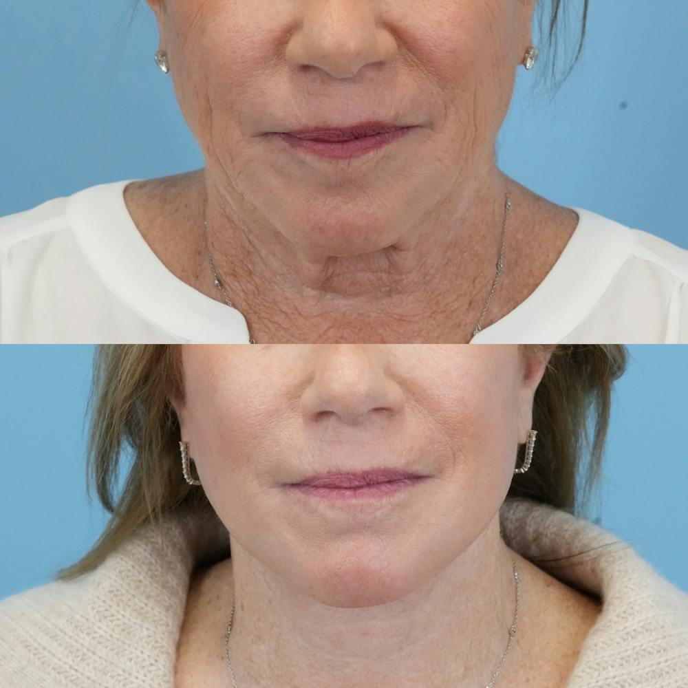 Facelift Before & After Gallery - Patient 300532 - Image 1