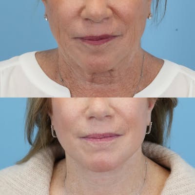 Facelift Before & After Gallery - Patient 300532 - Image 1