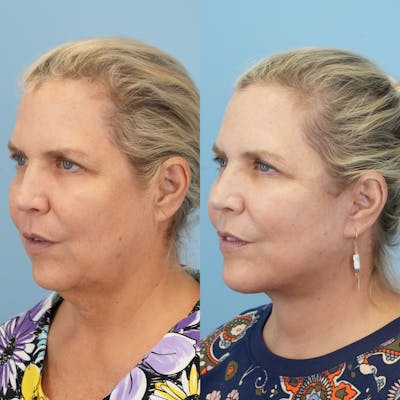 Facelift Before & After Gallery - Patient 270497 - Image 4