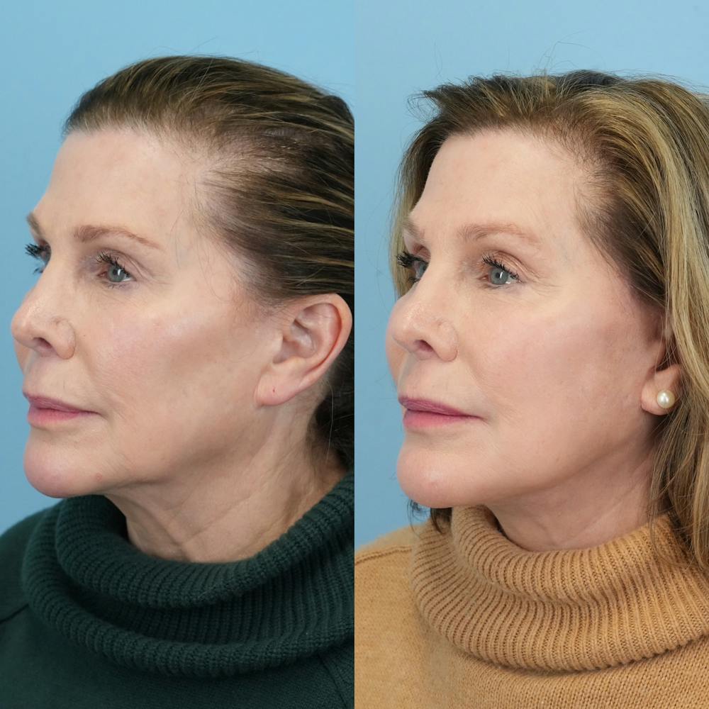 Facelift Before & After Gallery - Patient 212683 - Image 4