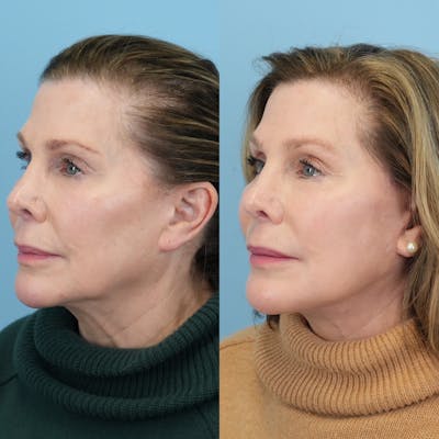 Facelift Before & After Gallery - Patient 212683 - Image 4