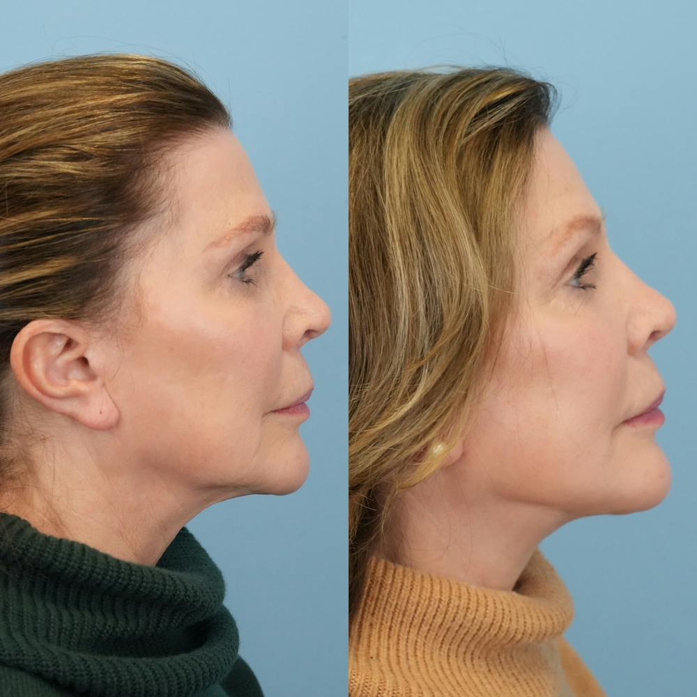 Facelift Before & After Gallery - Patient 212683 - Image 3