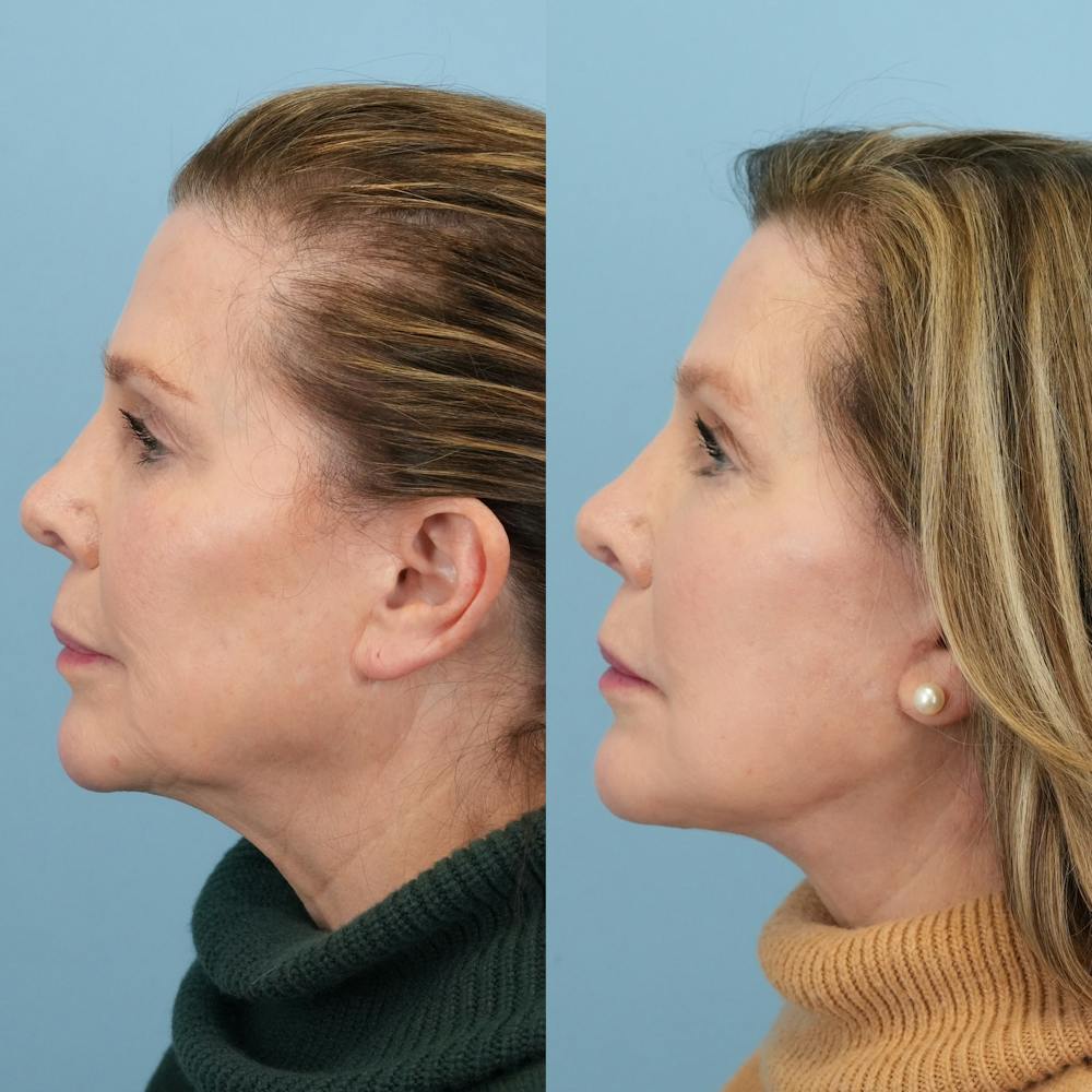 Facelift Before & After Gallery - Patient 212683 - Image 5