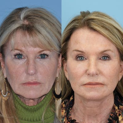 Facelift Before & After Gallery - Patient 722216 - Image 2