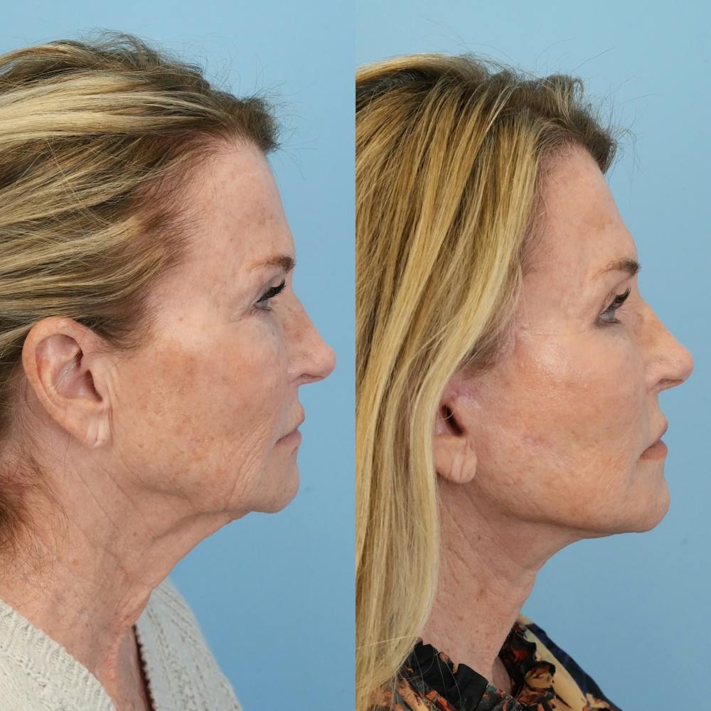 Facelift Before & After Gallery - Patient 722216 - Image 4