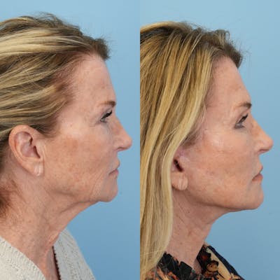 Facelift Before & After Gallery - Patient 722216 - Image 4