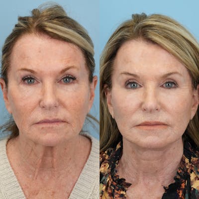 Facelift Before & After Gallery - Patient 722216 - Image 1