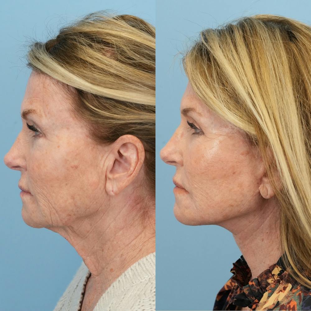 Facelift Before & After Gallery - Patient 722216 - Image 6
