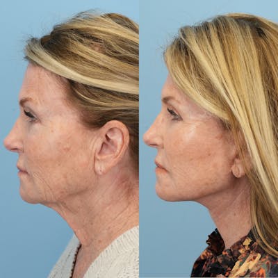 Facelift Before & After Gallery - Patient 722216 - Image 6