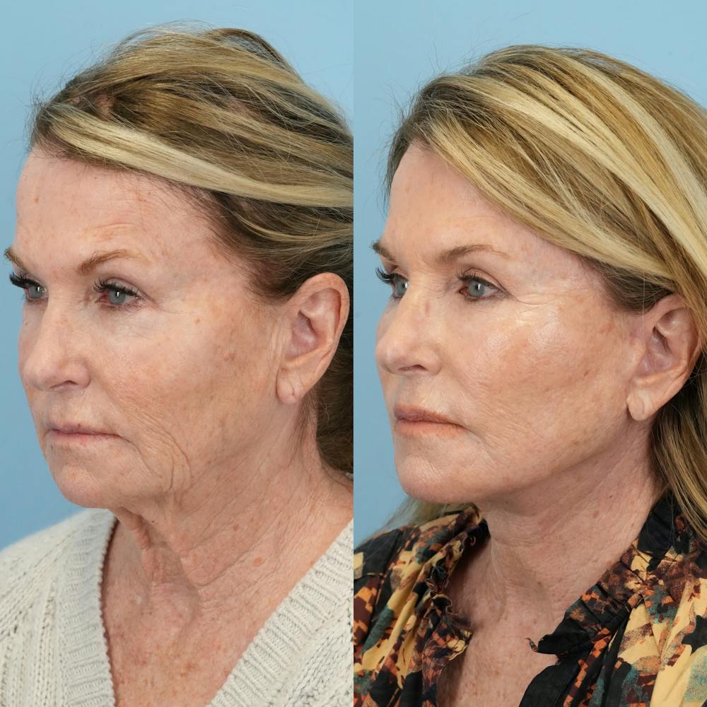 Facelift Before & After Gallery - Patient 722216 - Image 5