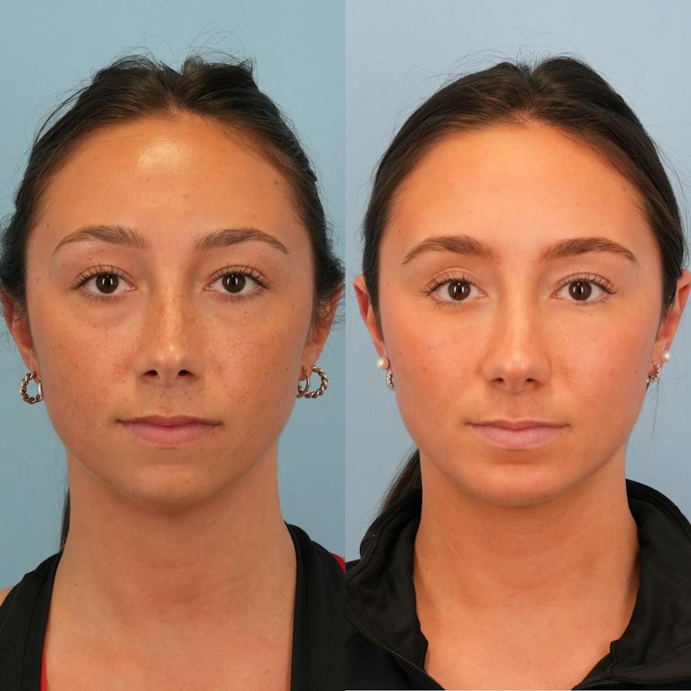 Chin Implants Before & After Gallery - Patient 342003 - Image 3