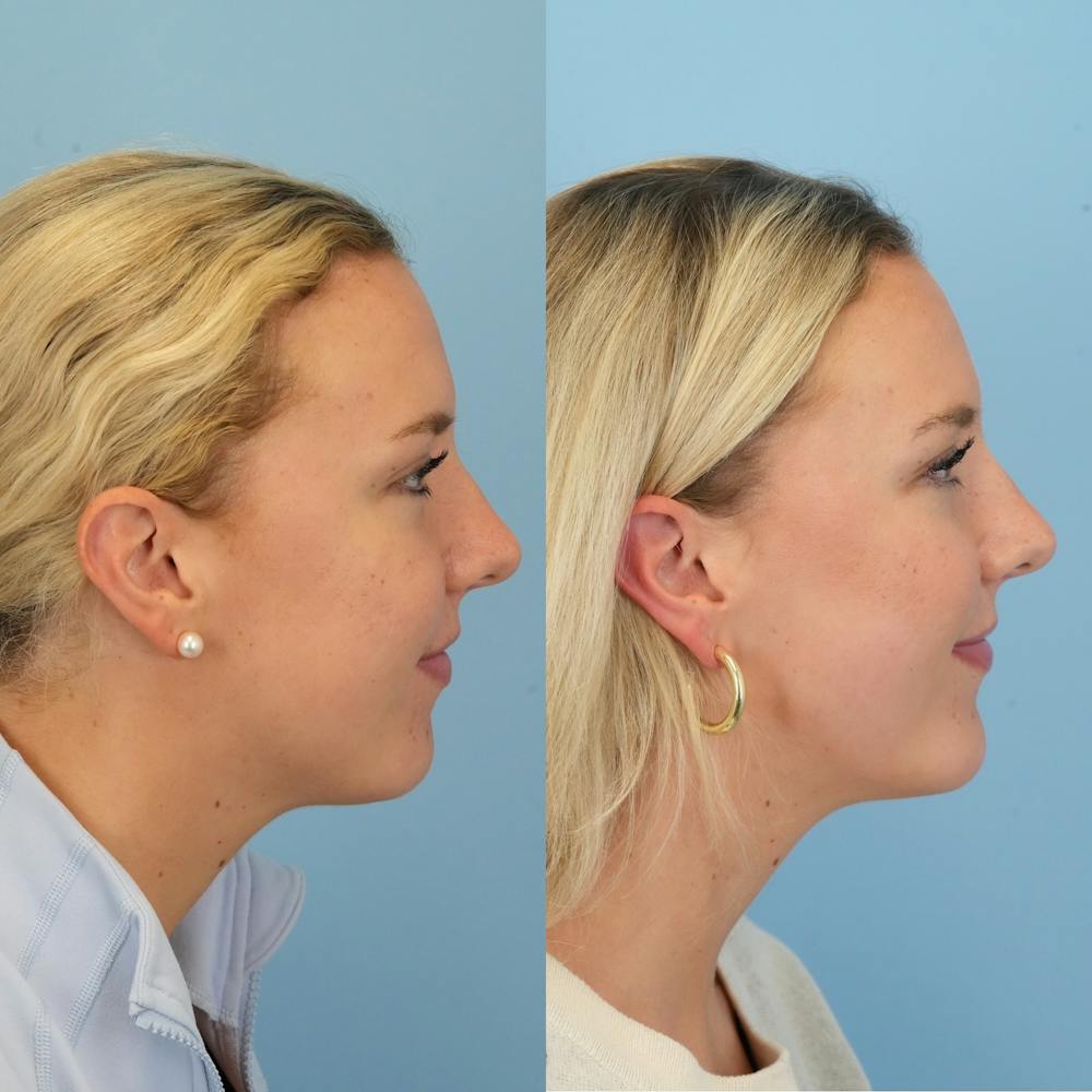 Chin Implants Before & After Gallery - Patient 797749 - Image 5