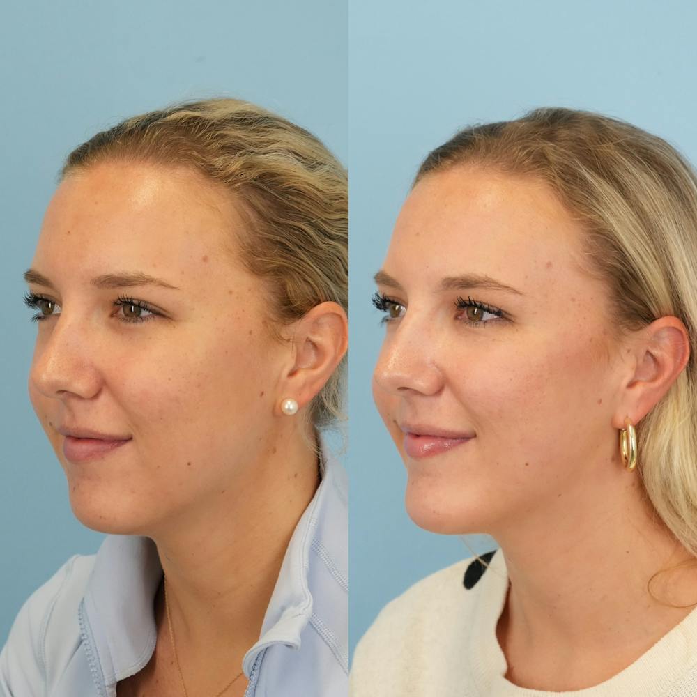 Chin Implants Before & After Gallery - Patient 797749 - Image 2