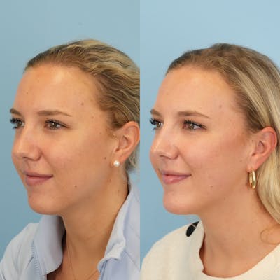 Chin Implants Before & After Gallery - Patient 797749 - Image 2