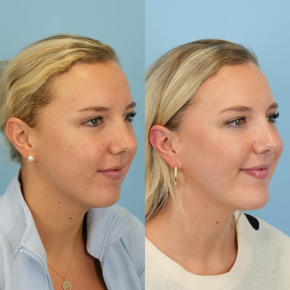 Chin Implants Before & After Gallery - Patient 797749 - Image 4