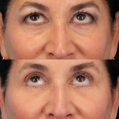 Blepharoplasty Before & After Gallery - Patient 411455 - Image 2