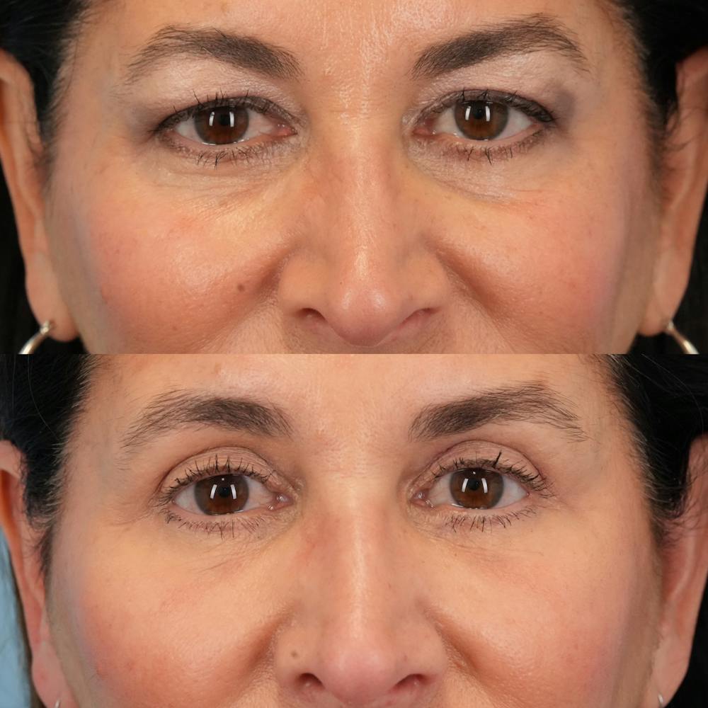 Blepharoplasty Before & After Gallery - Patient 411455 - Image 1