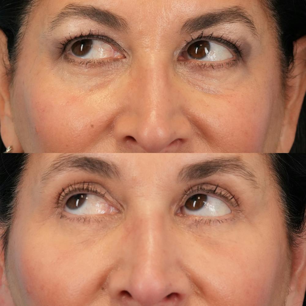 Blepharoplasty Before & After Gallery - Patient 411455 - Image 5