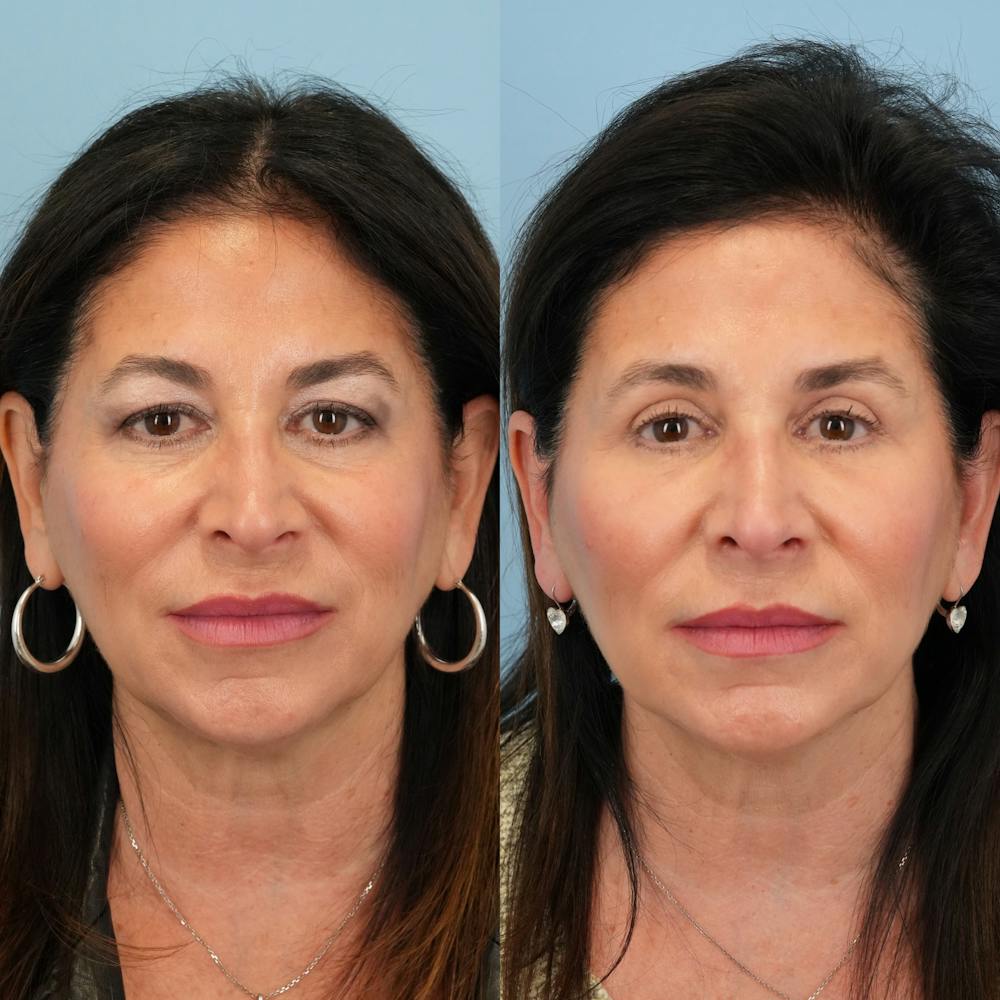 Blepharoplasty Before & After Gallery - Patient 411455 - Image 6