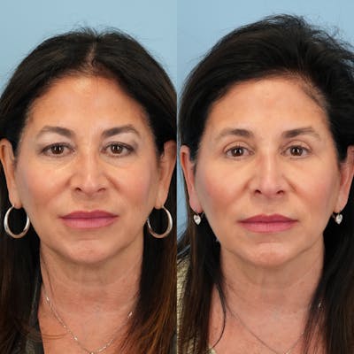 Blepharoplasty Before & After Gallery - Patient 411455 - Image 6