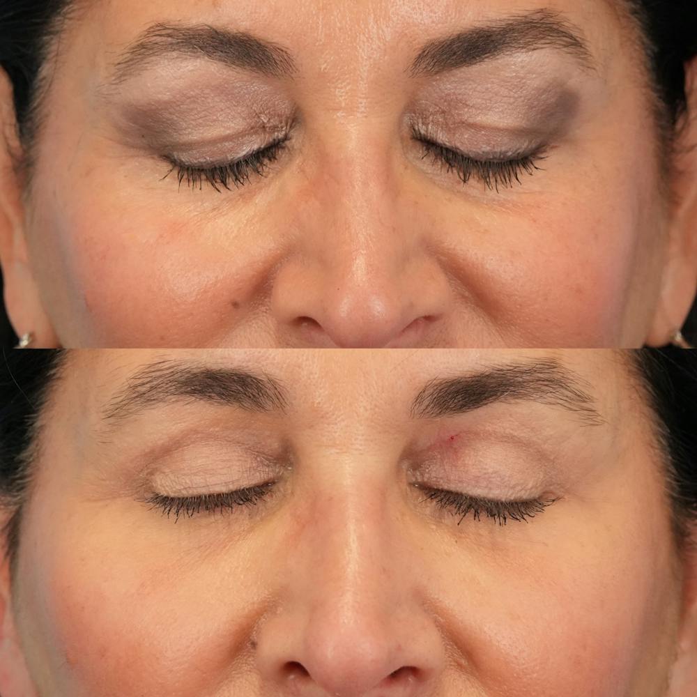 Blepharoplasty Before & After Gallery - Patient 411455 - Image 3