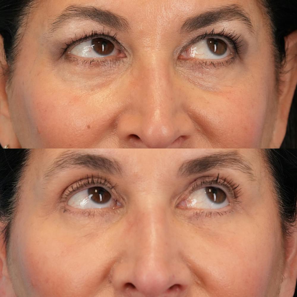 Blepharoplasty Before & After Gallery - Patient 411455 - Image 4