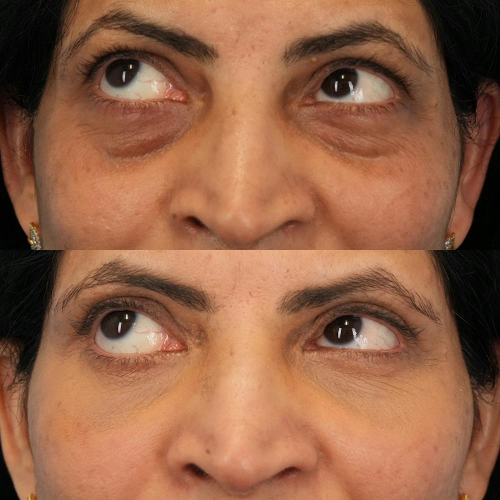 Blepharoplasty Before & After Gallery - Patient 230987 - Image 5