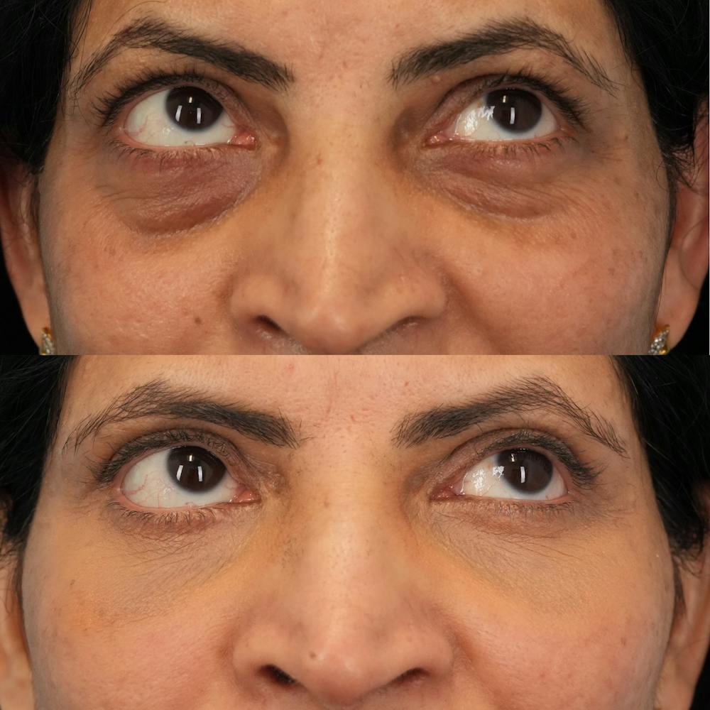 Blepharoplasty Before & After Gallery - Patient 230987 - Image 4