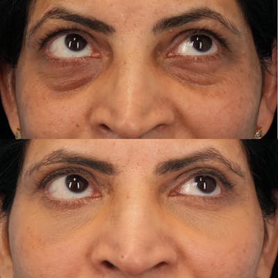 Blepharoplasty Before & After Gallery - Patient 230987 - Image 4