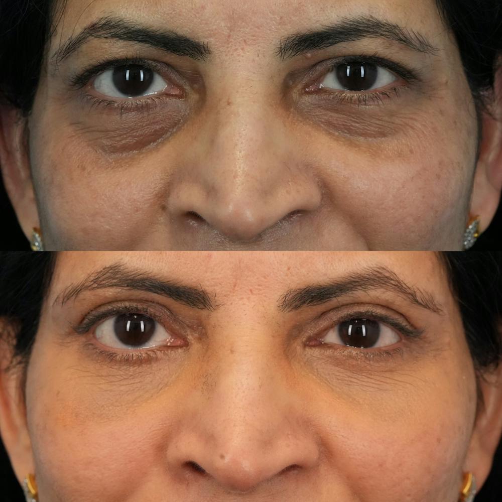 Blepharoplasty Before & After Gallery - Patient 230987 - Image 1