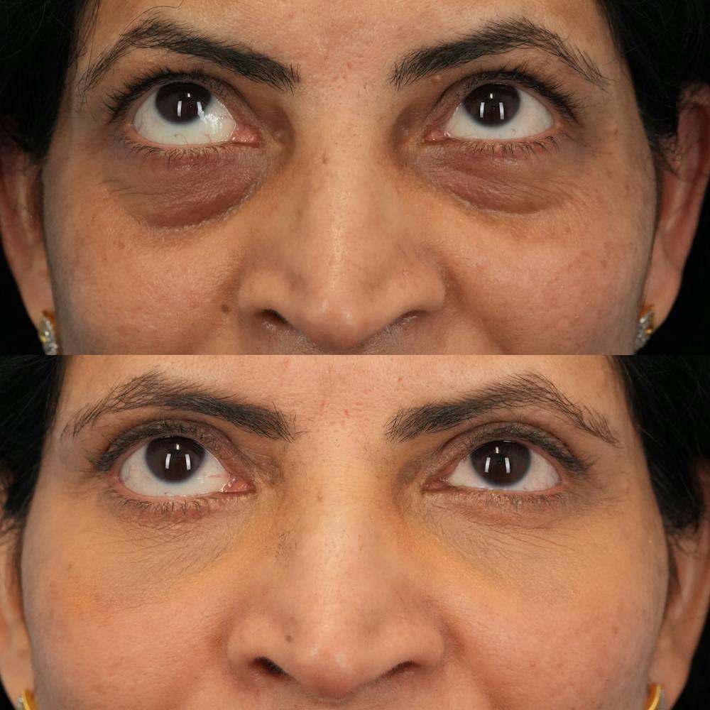 Blepharoplasty Before & After Gallery - Patient 230987 - Image 2