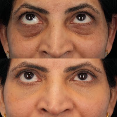 Blepharoplasty Before & After Gallery - Patient 230987 - Image 2