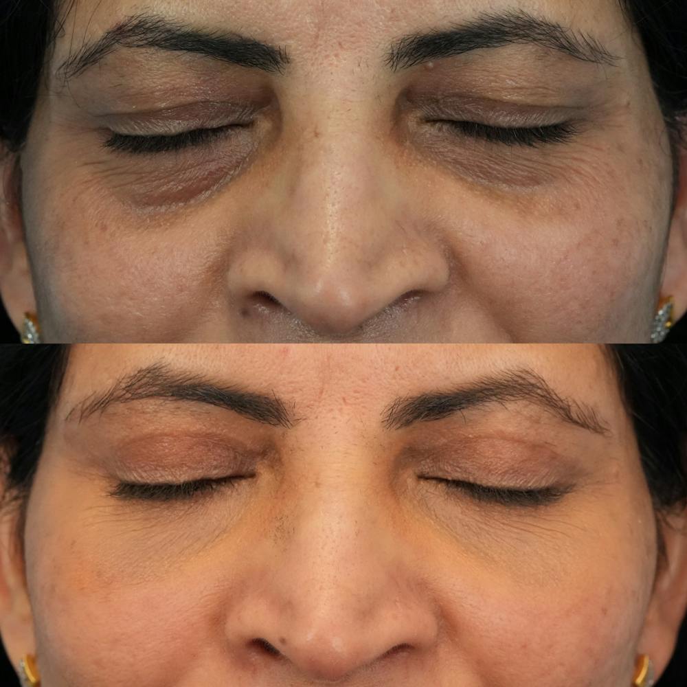 Blepharoplasty Before & After Gallery - Patient 230987 - Image 3