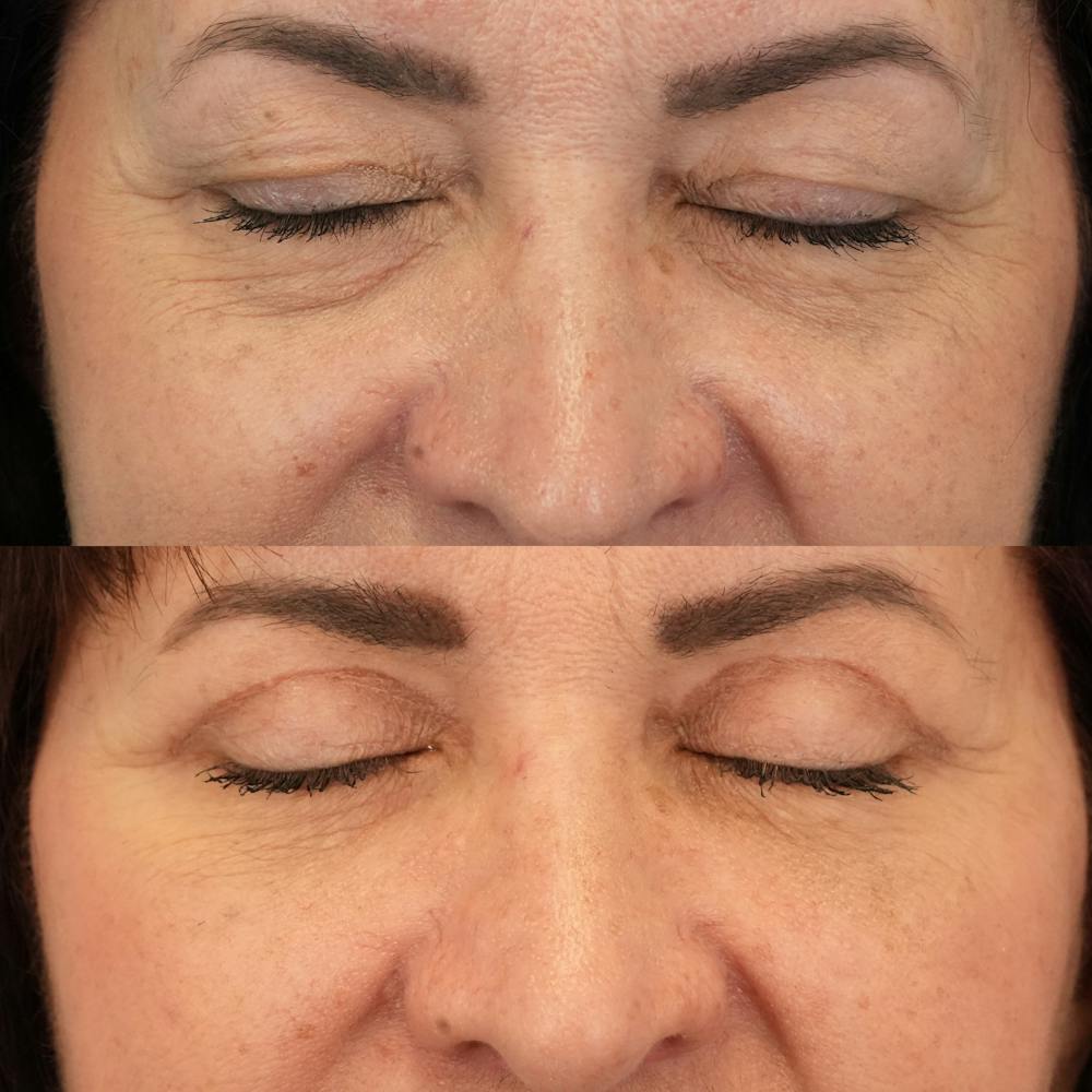 Blepharoplasty Before & After Gallery - Patient 248604 - Image 3
