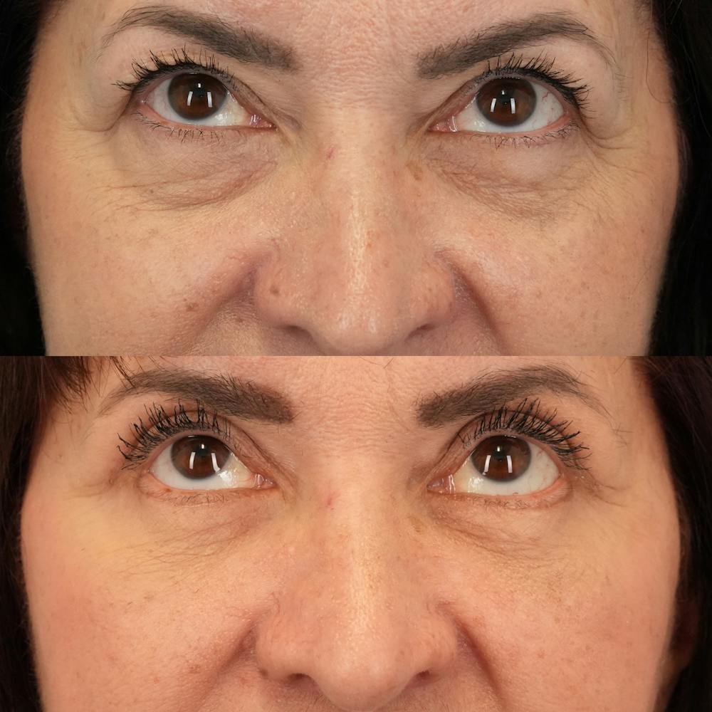 Blepharoplasty Before & After Gallery - Patient 248604 - Image 2