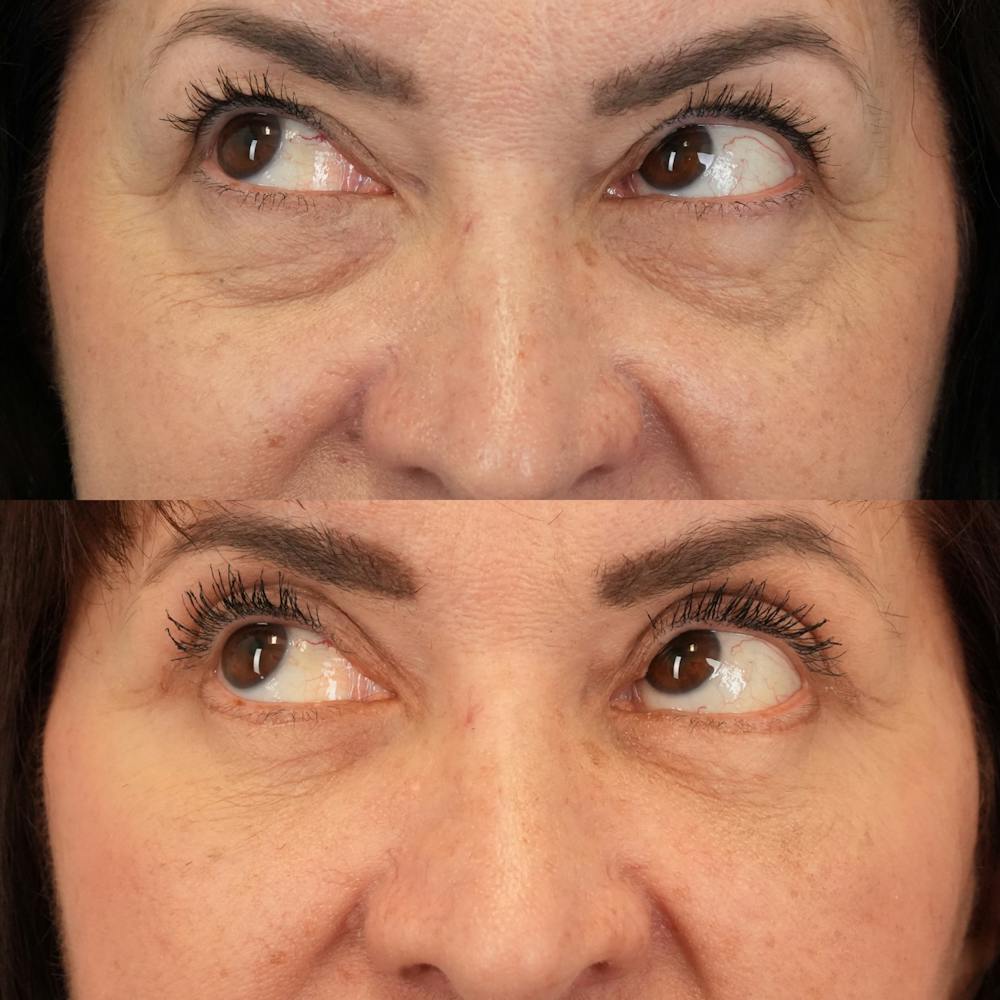 Blepharoplasty Before & After Gallery - Patient 248604 - Image 5