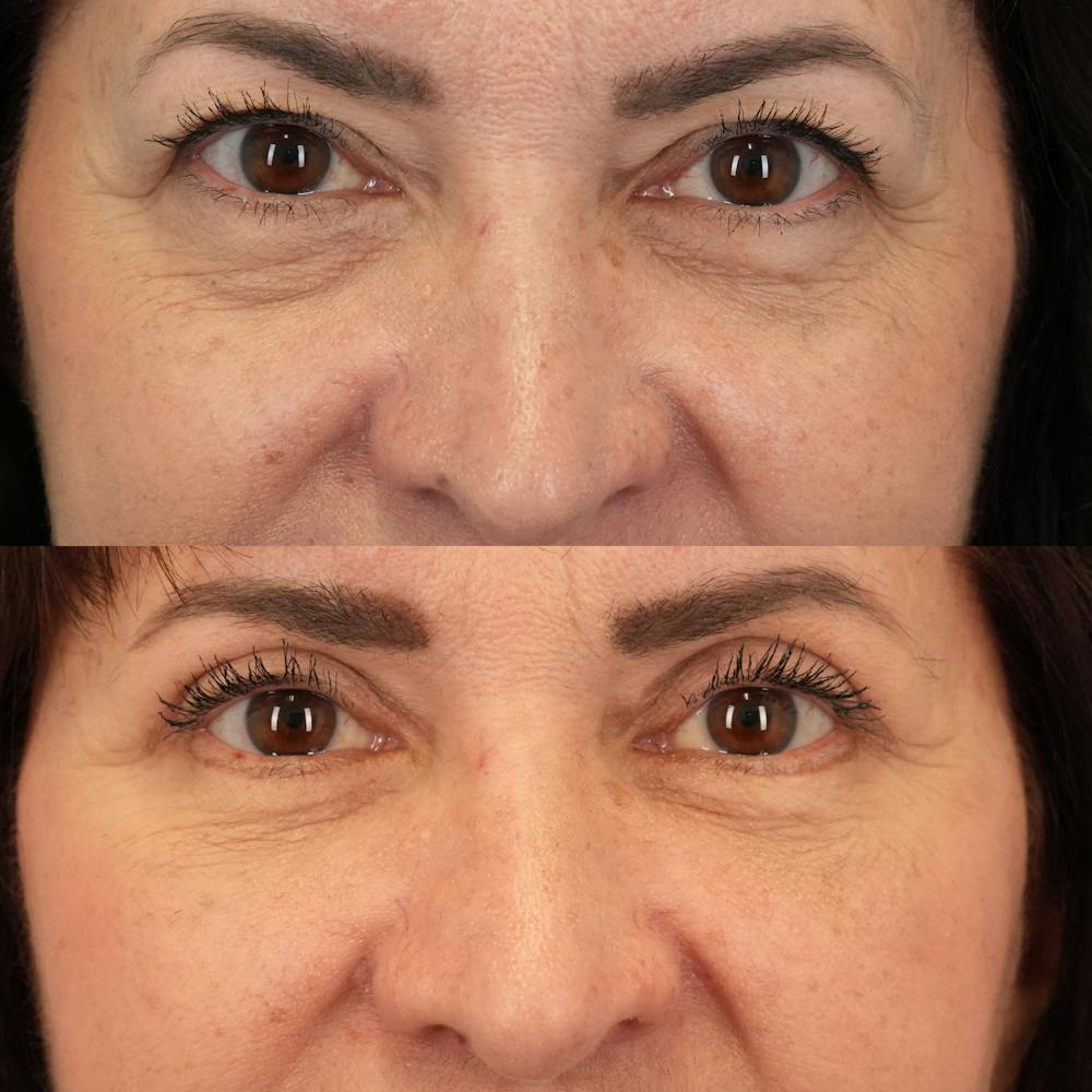 Blepharoplasty Before & After Gallery - Patient 248604 - Image 1