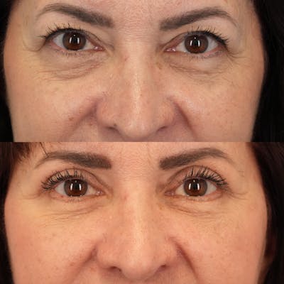 Blepharoplasty Before & After Gallery - Patient 248604 - Image 1