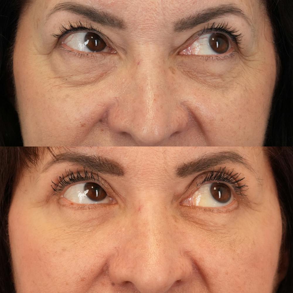 Blepharoplasty Before & After Gallery - Patient 248604 - Image 4