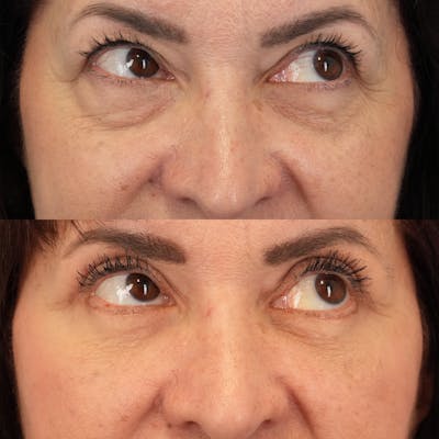 Blepharoplasty Before & After Gallery - Patient 248604 - Image 4