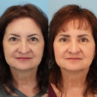 Blepharoplasty Before & After Gallery - Patient 248604 - Image 6