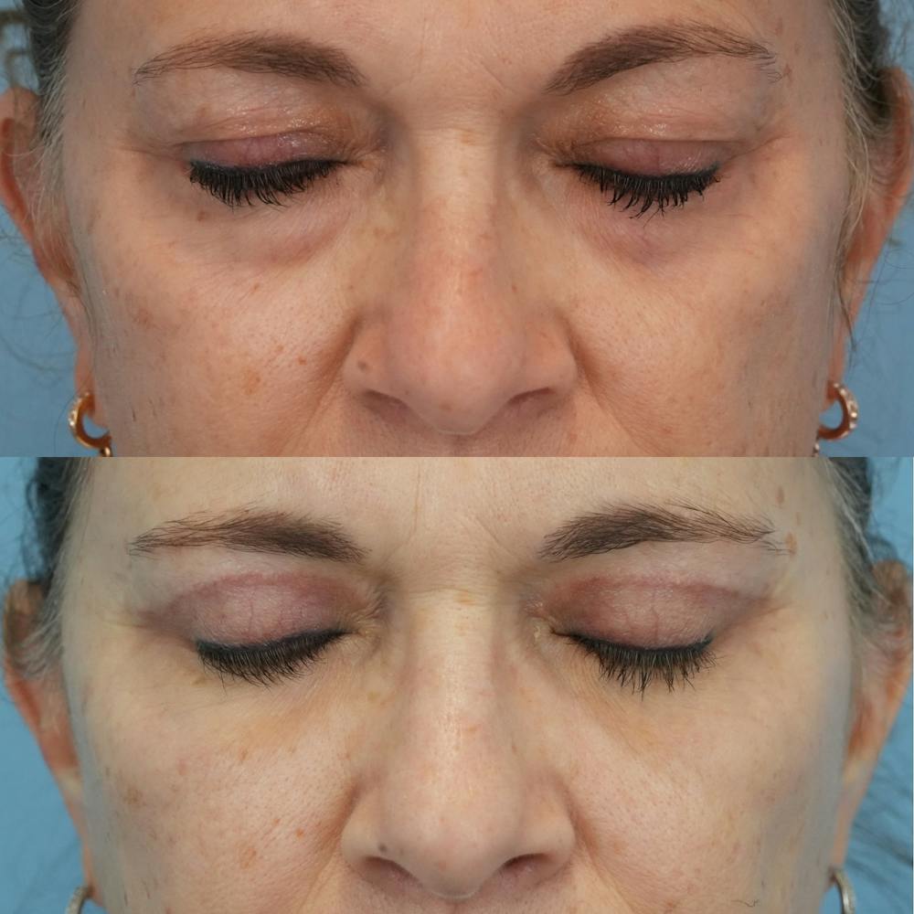 Blepharoplasty Before & After Gallery - Patient 576224 - Image 3